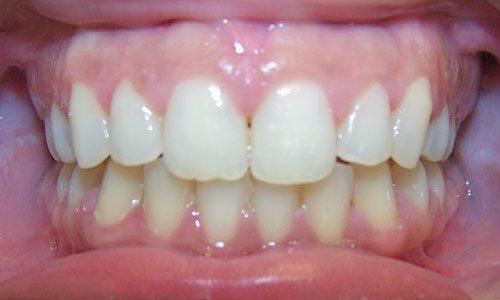 Patient smile after orthodontic treatment (case 22)
