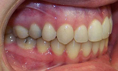 Patient smile after orthodontic treatment (case 21)