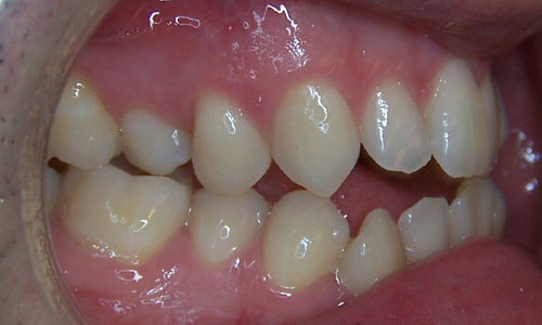 Patient smile before orthodontic treatment (case 2)