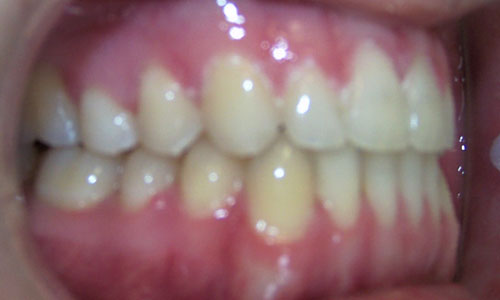 Patient smile after orthodontic treatment (case 2)
