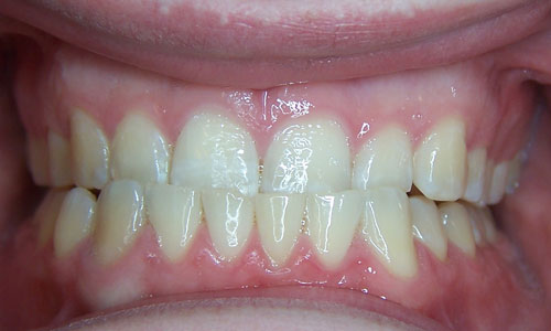 Patient smile before orthodontic treatment (case 3)