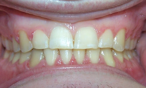 Patient smile after orthodontic treatment (case 3)