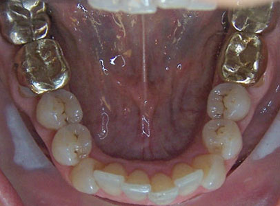 Patient smile before orthodontic treatment (case 32)
