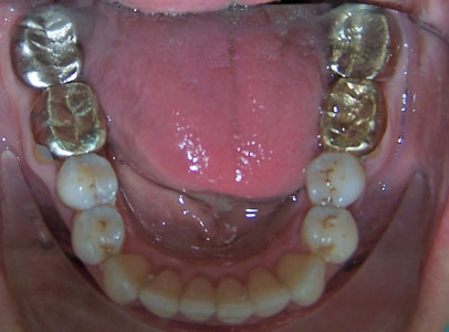Patient smile after orthodontic treatment (case 32)