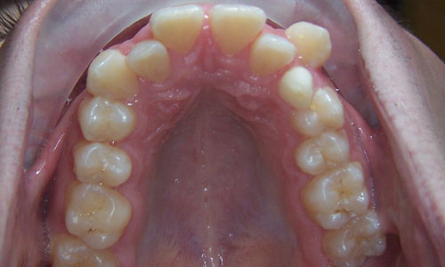 Patient smile before orthodontic treatment (case 4)