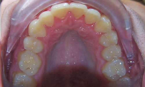 Patient smile after orthodontic treatment (case 4)
