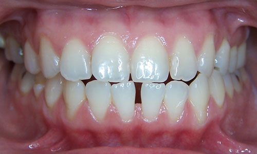 Patient smile before orthodontic treatment (case 5)