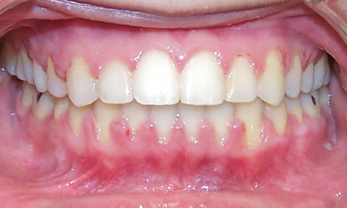 Patient smile after orthodontic treatment (case 5)