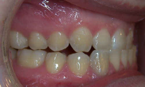 Patient smile before orthodontic treatment (case 6)