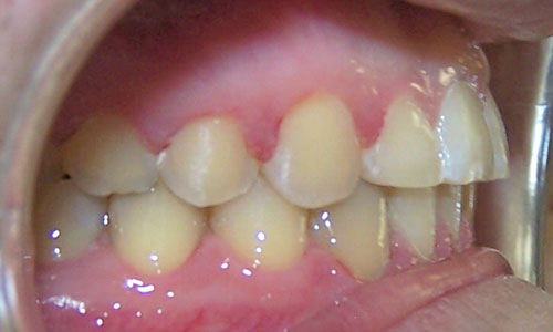 Patient smile after orthodontic treatment (case 6)