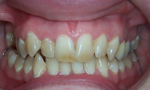 Patient smile before orthodontic treatment (case 7)