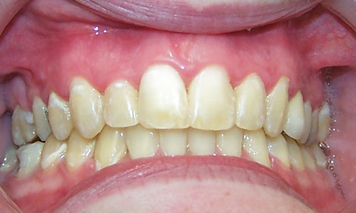 Patient smile after orthodontic treatment (case 7)