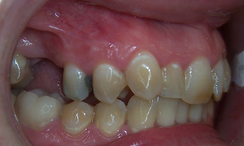 Patient smile before orthodontic treatment (case 8)
