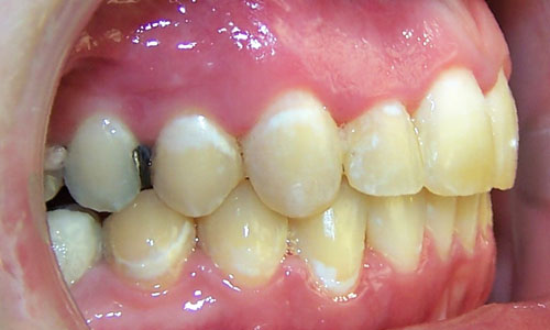 Patient smile after orthodontic treatment (case 8)