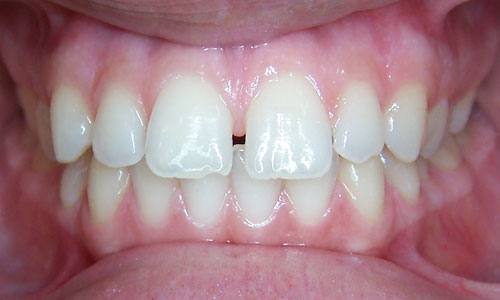 Patient smile before orthodontic treatment (case 8)