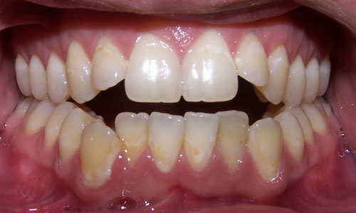 Patient smile before orthodontic treatment (case 9)