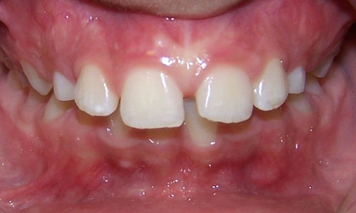 Patient smile before orthodontic treatment (case 8)