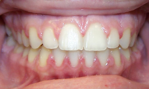 Patient smile after orthodontic treatment (case 8)
