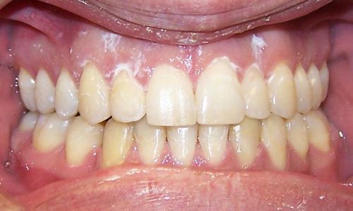 Patient smile after orthodontic treatment (case 9)