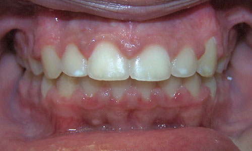 Patient smile after orthodontic treatment (case 8)