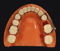 Distal Jet molar uprighter