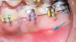 Blue arrow pointing to a sore or ulcer inside the mouth beside braces