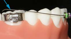 Blue arrow pointing to a wire that has come completely out of the molar tube