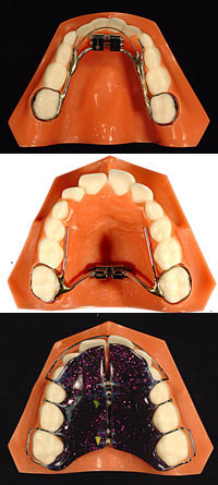 Fixed and removable palatal expanders