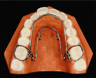 Quad helix appliance
