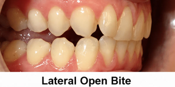 Lateral open bite caused by tongue posture