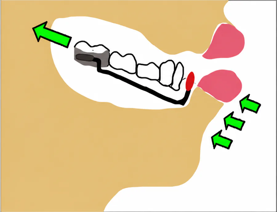 Lip bumper stretching the dental arch (Figure 2)