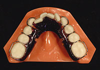 Lower sagittal appliance (active plate)