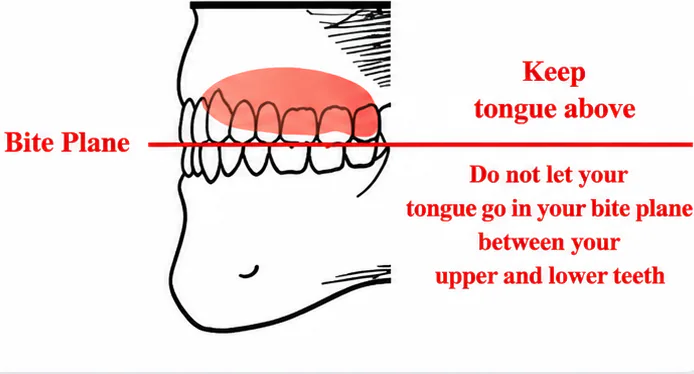 Illustration of correct resting tongue posture above the bite plane