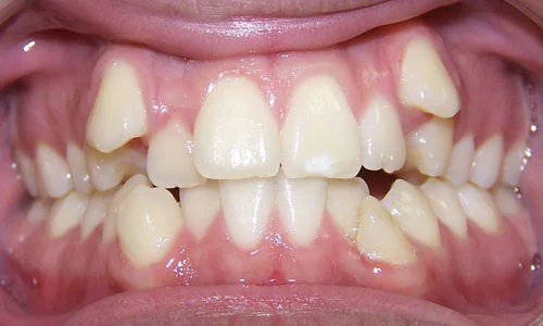 Patient smile before orthodontic treatment at The Braces Place