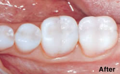 cerec-dentistry-after