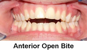 anterior-open-bite